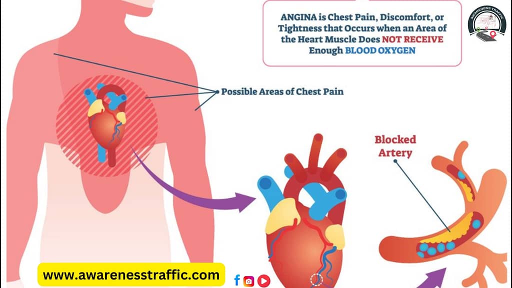 Angina