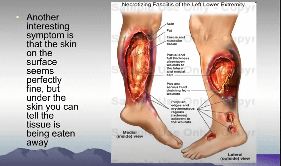 image credit goest to nicloteacher youtube channel Necrotizing Fasciitis
